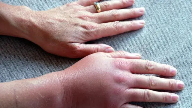 Piqure de guepe allergie